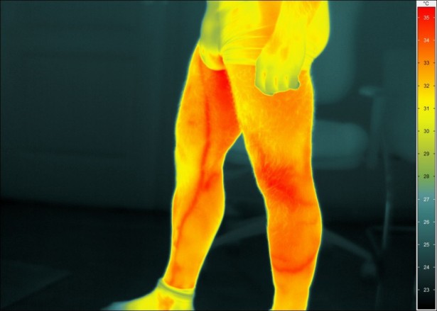 A sztrók megelőzése termográfia segítségével
